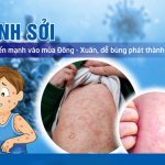 Không chủ quan với bệnh sởi có nguy cơ bùng phát